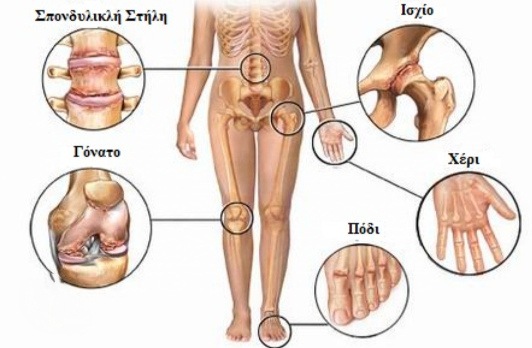 Οστεοαρθρίτιδα: Τι είναι και πώς βοηθάει η μέθοδος&nbsp;Pilates